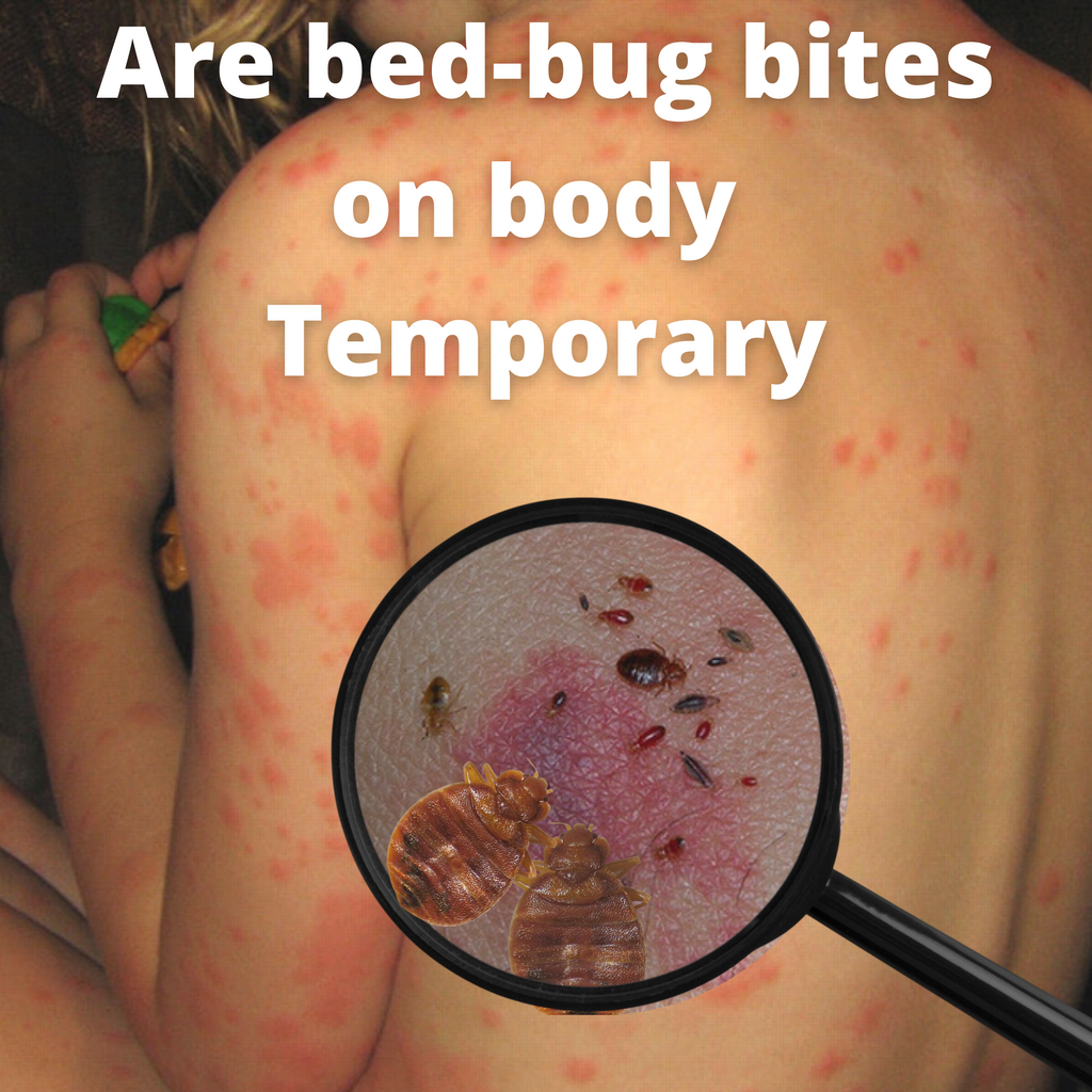 bed bug bites