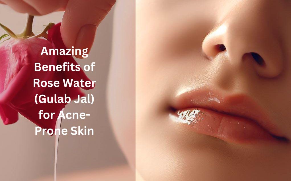 Amazing Benefits of Rose Water (Gulab Jal) for Acne-Prone Skin