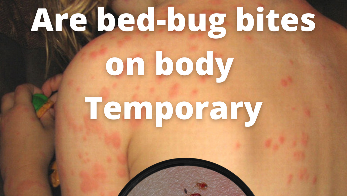 Are bed bug bites on the body temporary?